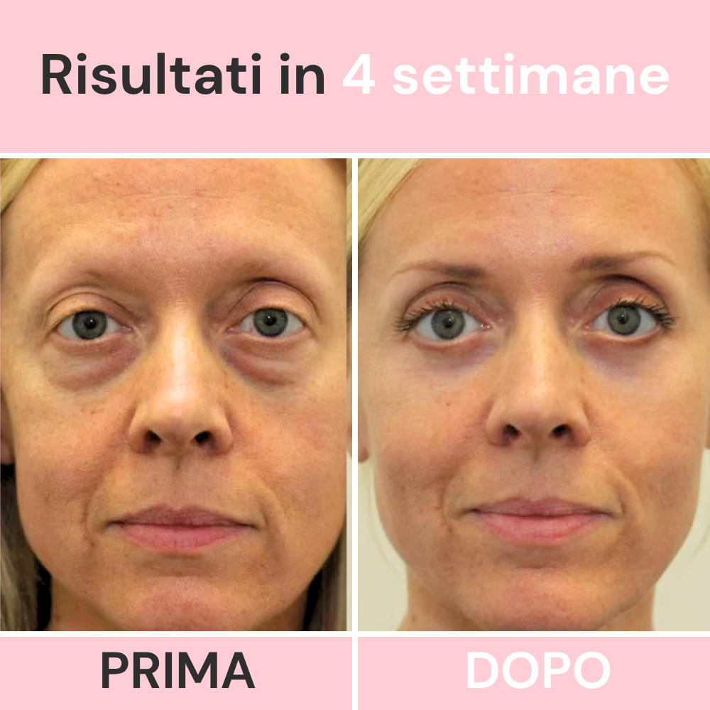 Sereina® MicroDerma  —  Sistema di Micronfusione