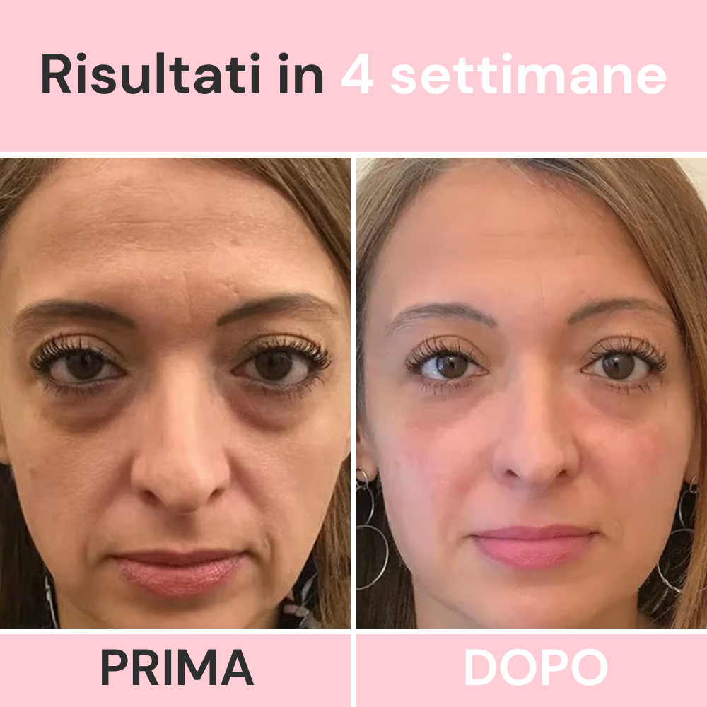 Sereina® MicroDerma  —  Sistema di Micronfusione